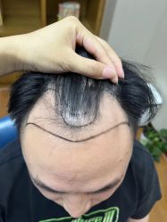 体验前-大麦微针植发全国连锁