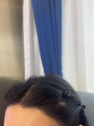 -碧莲盛·不剃发植发