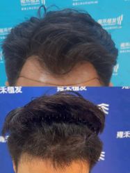 -雍禾植发