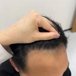 -大麦微针植发全国连锁