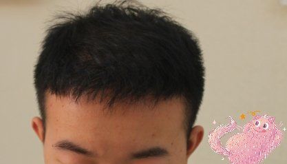 -大麦微针植发丨全国连锁