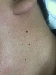 -爱莎扁平疣·汗管瘤·斑痣中心