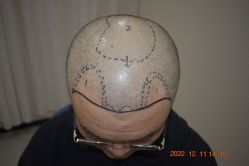 -大麦微针植发全国连锁