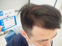 -大麦微针植发丨全国连锁