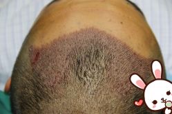 点击看大图 -大麦微针植发丨全国连锁