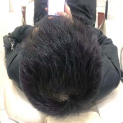 点击看大图 体验后-大麦微针植发全国连锁