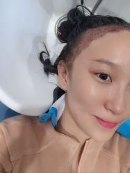 -大麦微针植发全国连锁
