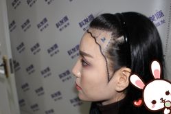 点击看大图 -大麦微针植发丨全国连锁