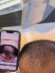 -碧莲盛·不剃发植发