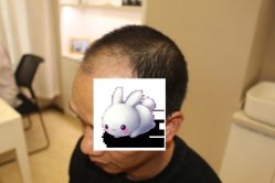 -大麦微针植发丨全国连锁