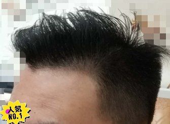 -大麦微针植发丨全国连锁