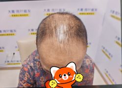-大麦微针植发丨全国连锁