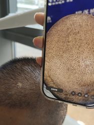 -碧莲盛·不剃发植发