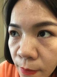 体验前-爱莎扁平疣·汗管瘤·斑痣中心