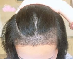 -大麦微针植发丨全国连锁