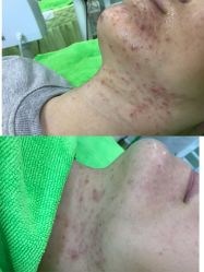 -清颜堂专业祛痘