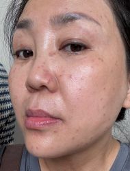 体验后-紫洁俪方（北京）医疗美容