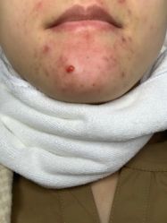 -蕾特恩专业祛痘国际连锁