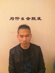 -碧莲盛·不剃发植发
