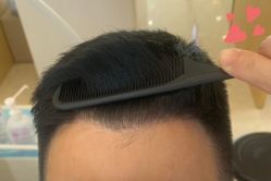 -大麦微针植发丨全国连锁