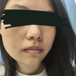 体验前-郑荃丽格医疗美容