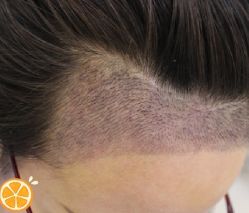 -大麦微针植发丨全国连锁