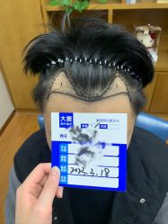 -大麦微针植发全国连锁