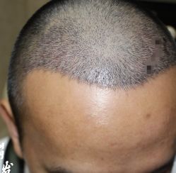 -大麦微针植发丨全国连锁