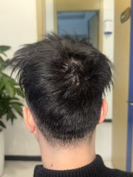 体验前-大麦微针植发全国连锁