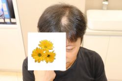 -大麦微针植发丨全国连锁