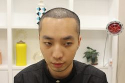 点击看大图 -大麦微针植发丨全国连锁