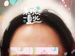 -大麦微针植发全国连锁