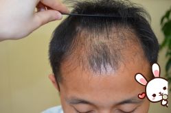 -大麦微针植发丨全国连锁