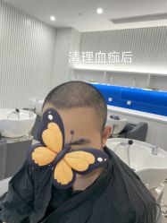 -北京雍禾植发医院
