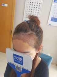 -大麦微针植发丨全国连锁