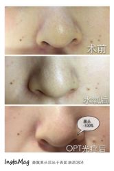 脸部抗衰-光SPA科技美肤