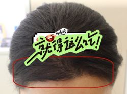 -大麦微针植发全国连锁