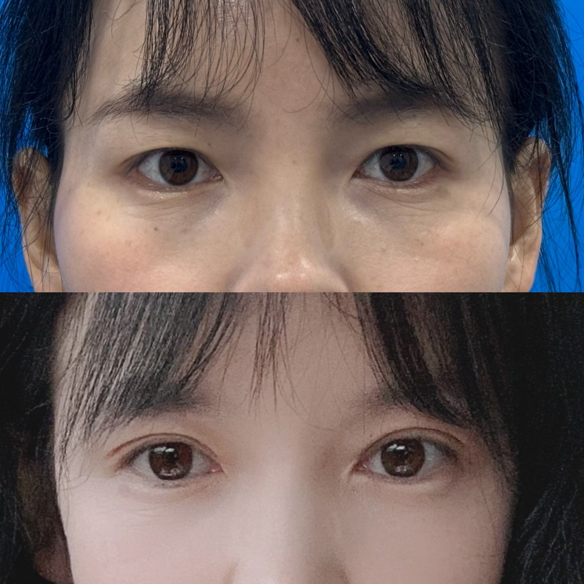 割双眼皮前后对比