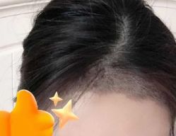 -大麦微针植发丨全国连锁