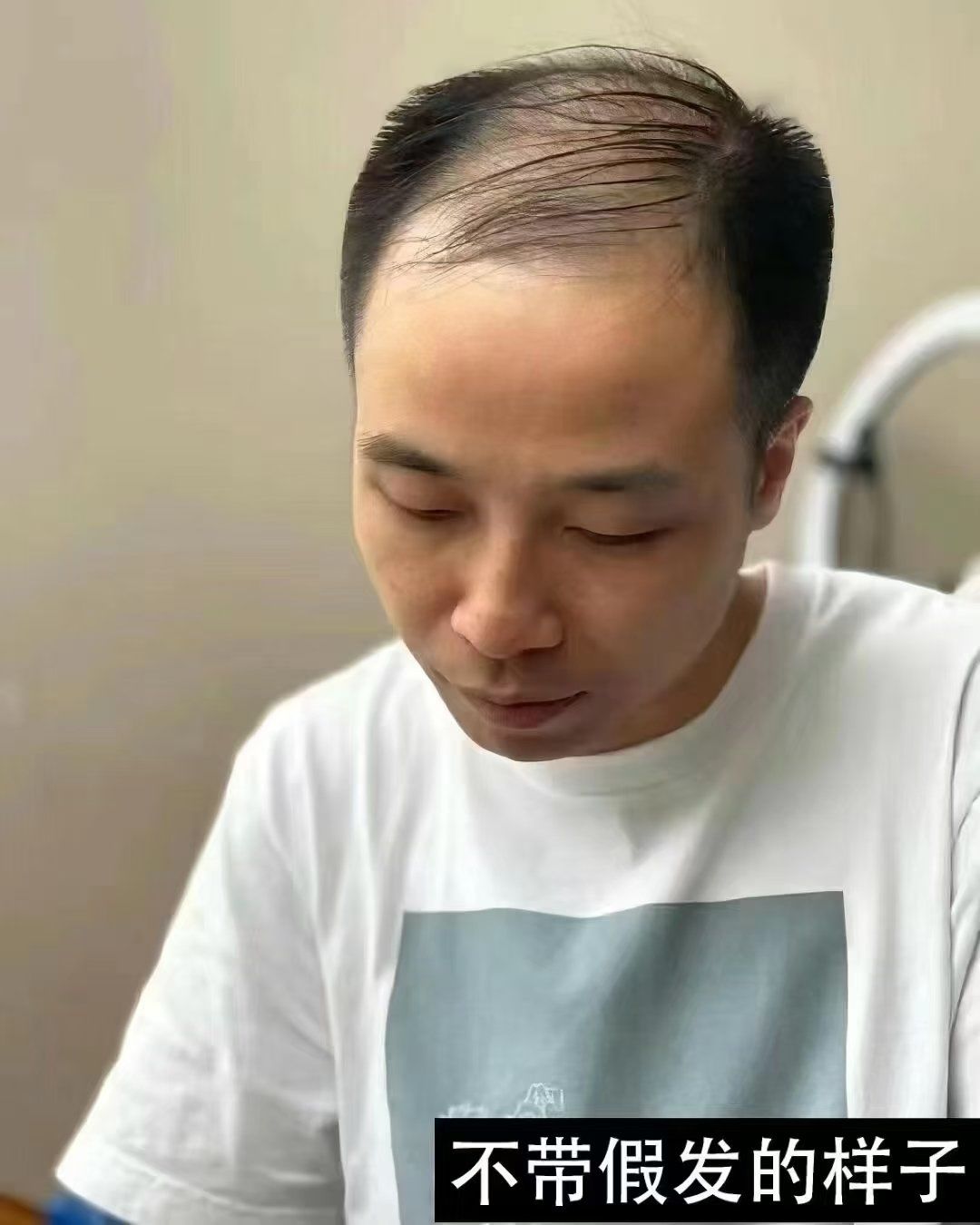 男士脱发克星