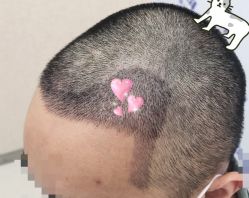 -大麦微针植发全国连锁