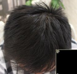 -大麦微针植发丨全国连锁