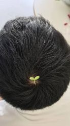 -大麦微针植发丨全国连锁