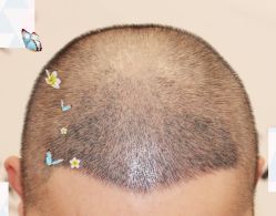 -大麦微针植发全国连锁