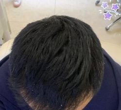 -大麦微针植发丨全国连锁