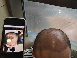 -碧莲盛·不剃发植发