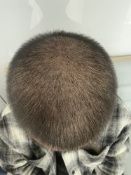 -大麦微针植发丨全国连锁