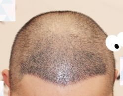 -大麦微针植发全国连锁