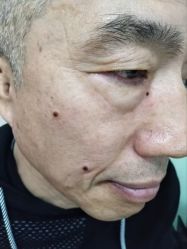 体验前-北京美痣堂古方祛痣斑疣瘊