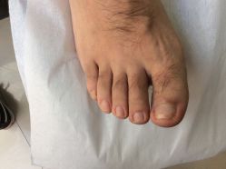 -德哥灰指甲脚气甲沟炎跖疣护理